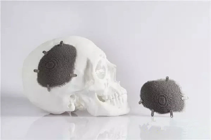 3D printed medical implants 3D printed medical implants